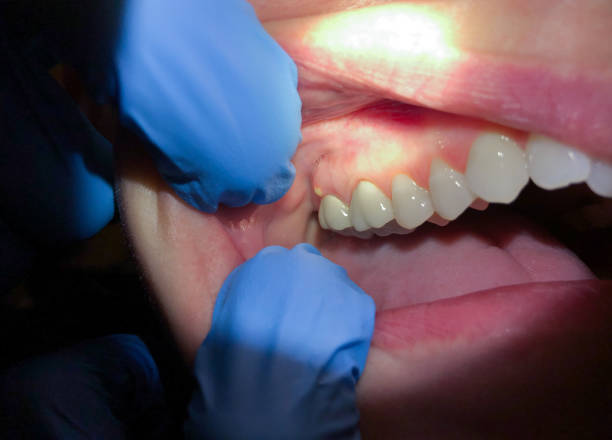 Best Emergency Root Canal Treatment in Beverly Hills, TX