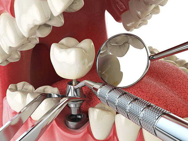 Best Emergency Wisdom Teeth Removal in Beverly Hills, TX
